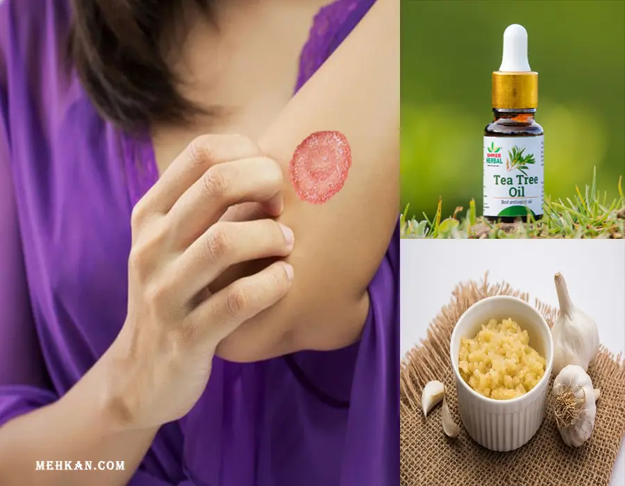 Natural remedies For Ringworm