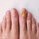 Toenail Fungal Infections