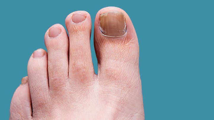 Toenail Fungal Infections