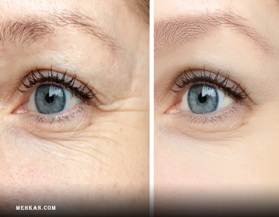 Under-Eye Wrinkles